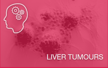 Quiz: A 74-year-old man with HCV-related compensated cirrhosis, a past smoking habit