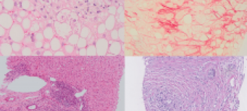 liver